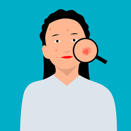 Dlaczego trądzik pojawia się u dorosłych? Najczęstsze przyczyny